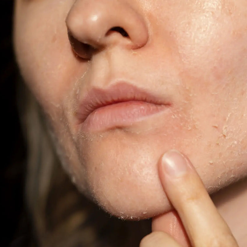 Dry Skin