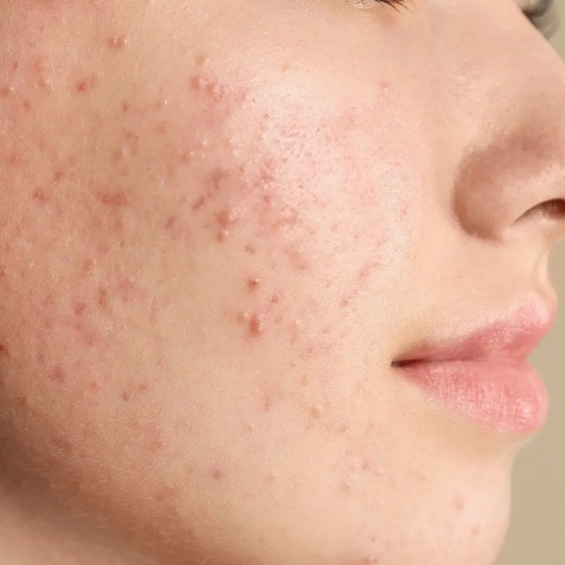 Acne